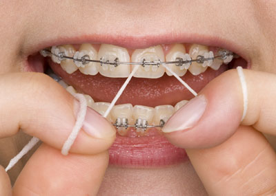 Zahnreinigung während der Zahnkorrektur