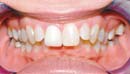 Grafik Damon System zu Kontrollterminen vergleicht Anzahl Termine Damon Zahnklammer mit herkömmliche Zahnkorrektur